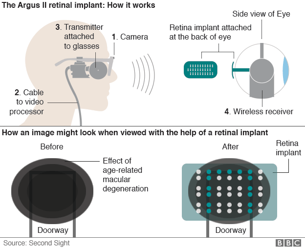 80 year old gets first bionic eye in the UK